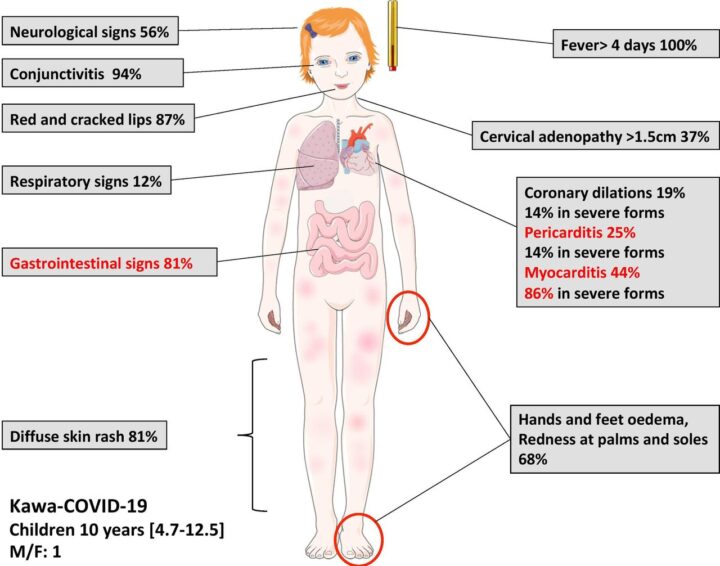Multisystem Inflammatory Syndrome in a Neonate With Prenatal Exposure to COVID‐19