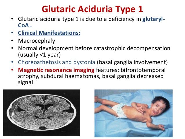 Infantile Tremor Syndrome Masquerading as Glutaric Aciduria Type 1
