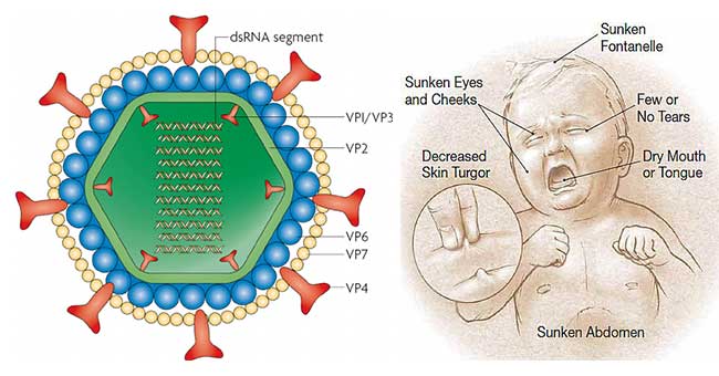 Rotavirus Infection with Systemic Dissemination in an Infant