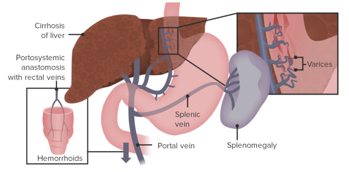 An Overt Gastrointestinal Bleeding and Splenomegaly Without Portal Hypertension in Celiac Disease